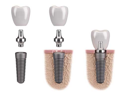 implante dental de titanio y corona de porcelana