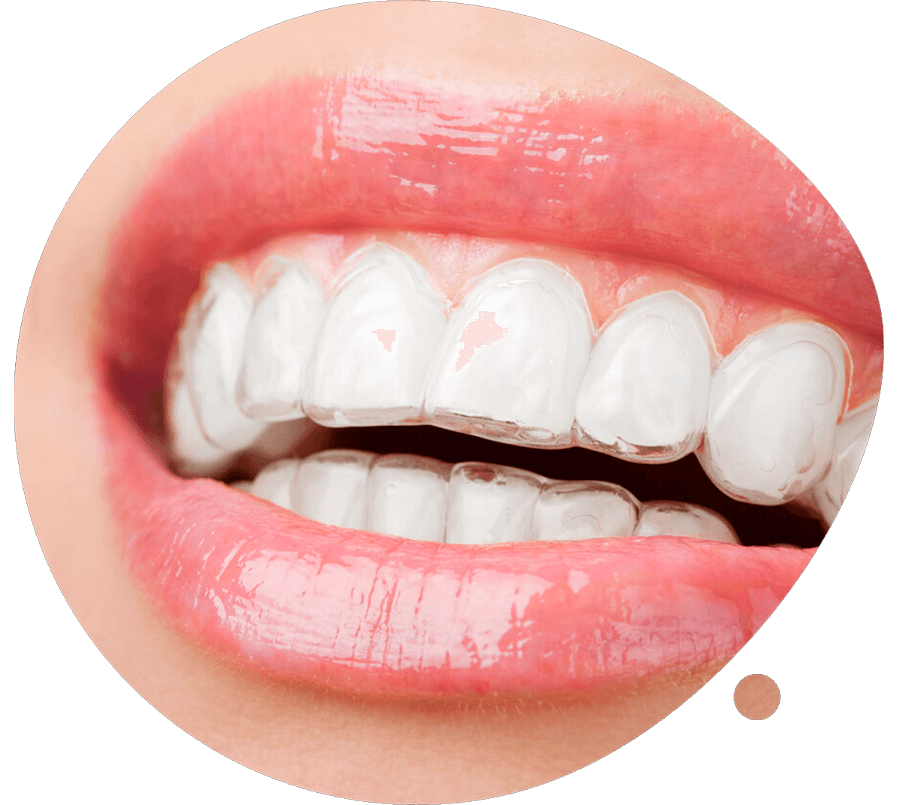 Ortodoncia invisible en la Clínica Dental La Vaguada