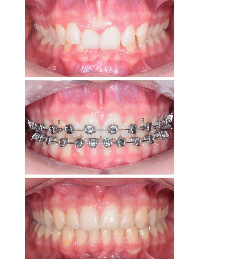 endocarditis infecciosa - tratamiento clinica dental pamplona endocarditis infecciosa - tratamiento clinica dental pamplona