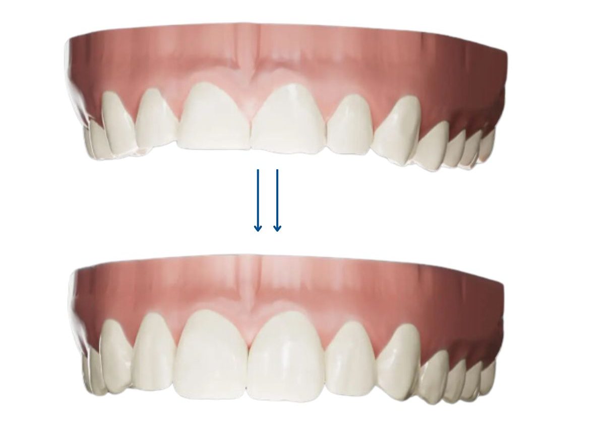 https://clinicadentallavaguada.com/wp-content/uploads/2024/07/carillas-firstfit-clinica-dental-la-vaguada-e1721664541663.jpg