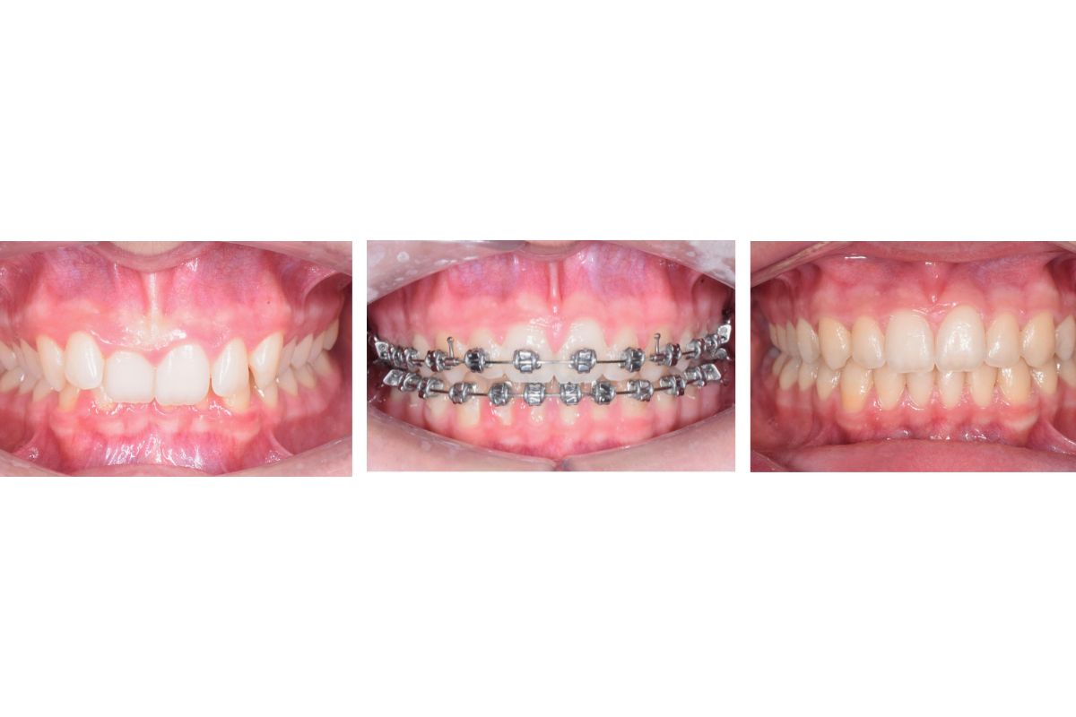 https://clinicadentallavaguada.com/wp-content/uploads/2024/07/ortodoncia-pamplona-brackets.jpg