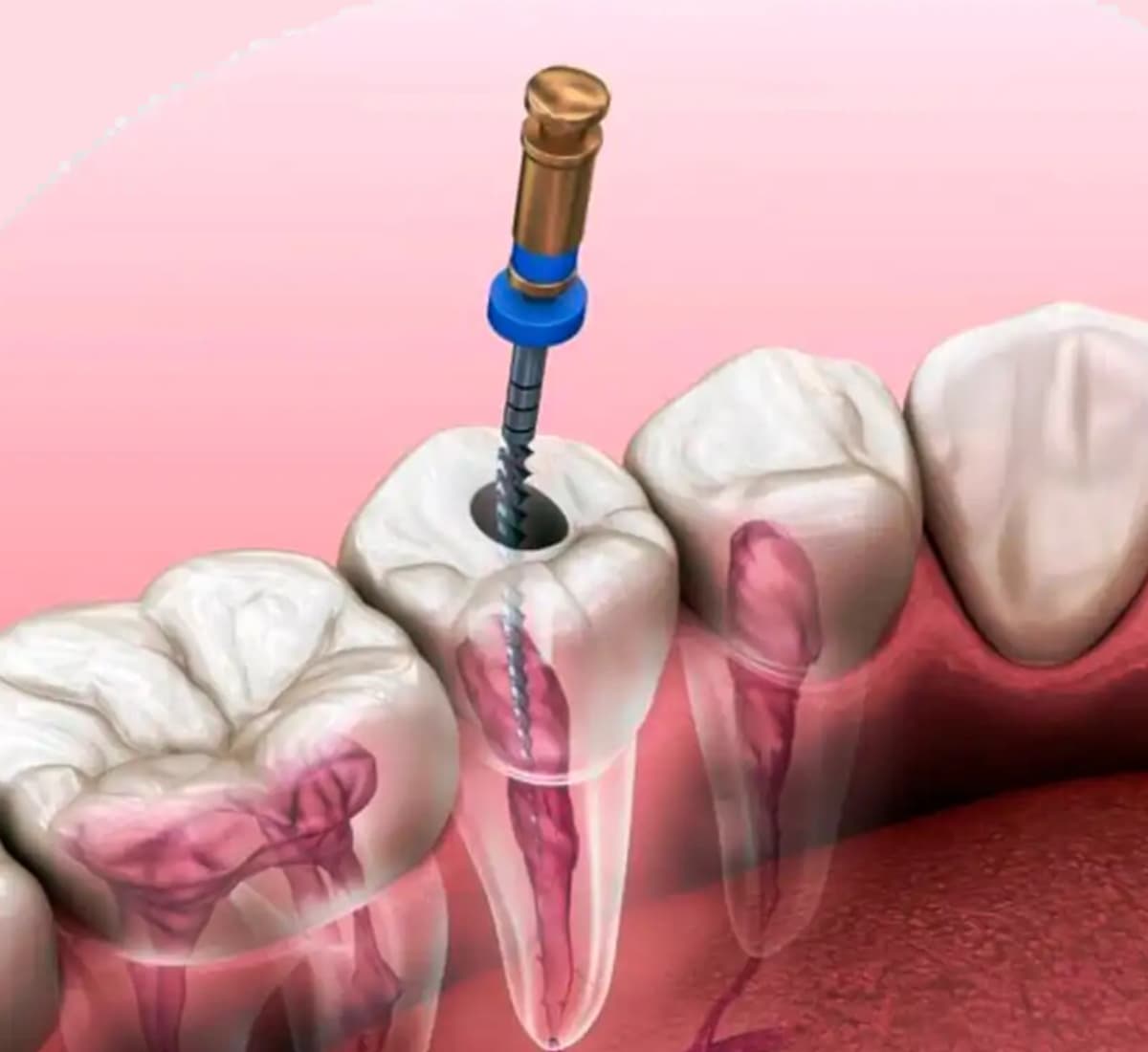 https://clinicadentallavaguada.com/wp-content/uploads/2024/09/endodoncia-clinica-dental-pamplona.jpg