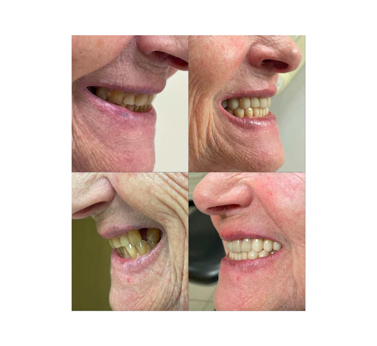 https://clinicadentallavaguada.com/wp-content/uploads/2024/10/carillas-dentales-porcelana-pamplona.jpg