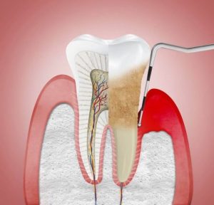 https://clinicadentallavaguada.com/wp-content/uploads/2024/11/periodontitis-pamplona-tratamiento.jpeg