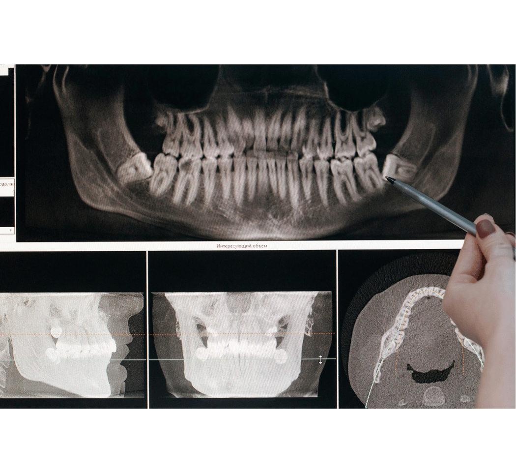 endocarditis infecciosa - tratamiento clinica dental pamplona endocarditis infecciosa - tratamiento clinica dental pamplona