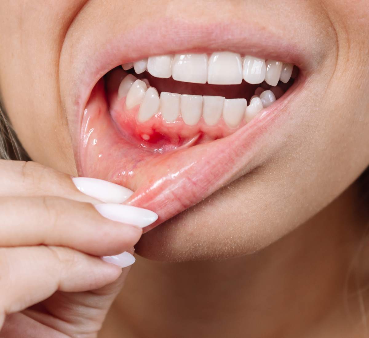 tratamiento sangrado de encias mejor dentista pamplona https://clinicadentallavaguada.com/wp-content/uploads/2025/10/tratamiento-sangrado-de-encias-mejor-dentista-pamplona.jpg