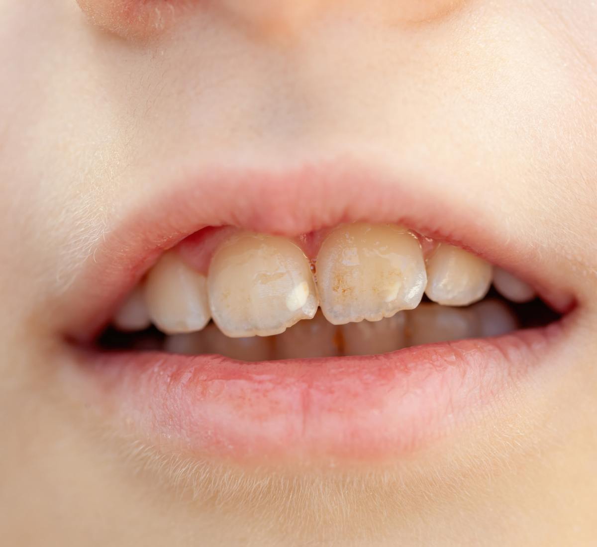 endocarditis infecciosa - tratamiento clinica dental pamplona