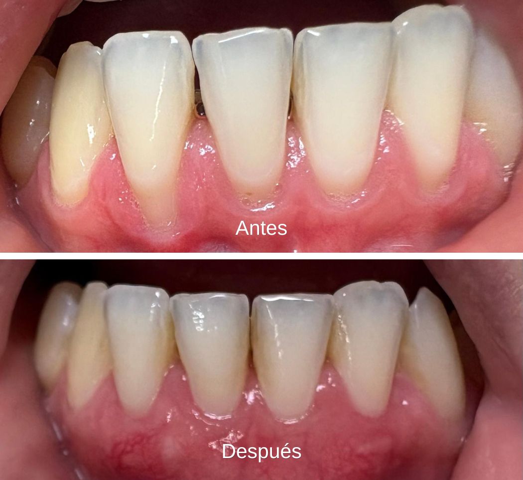 https://clinicadentallavaguada.com/wp-content/uploads/2026/03/injerto-de-encia-clinica-dental-vaguada.jpg